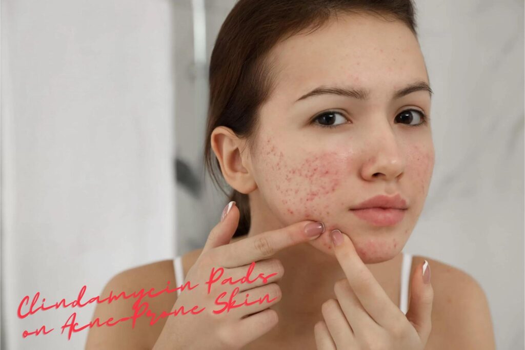 Influence of Clindamycin Pads on Acne-Prone Skin * 2024