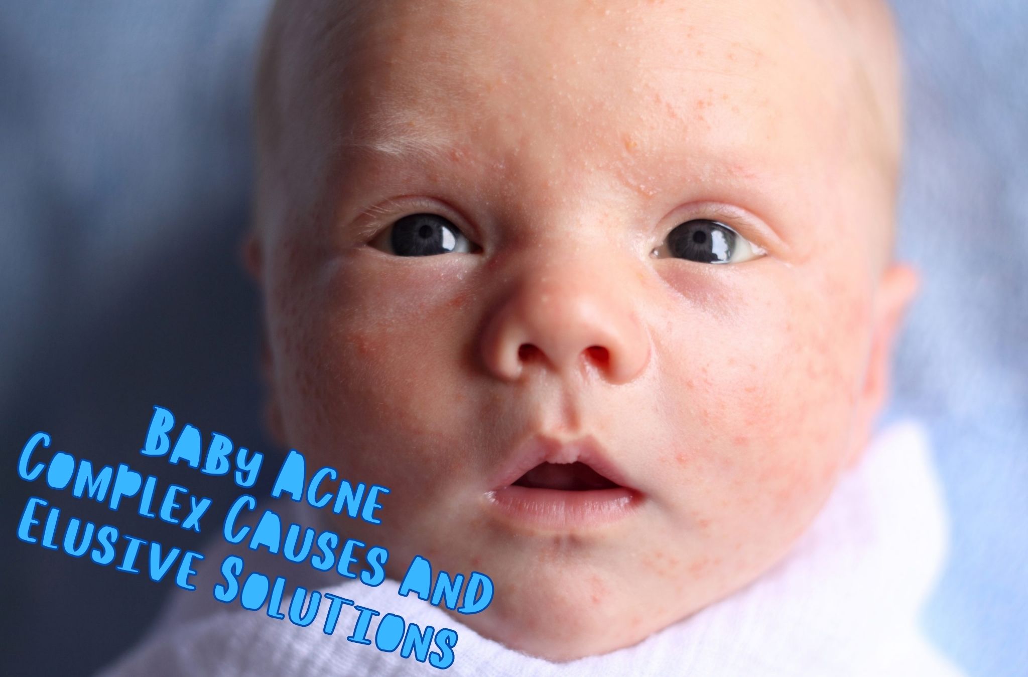 Baby Acne: Its Complex Causes and Elusive Solutions * 2024