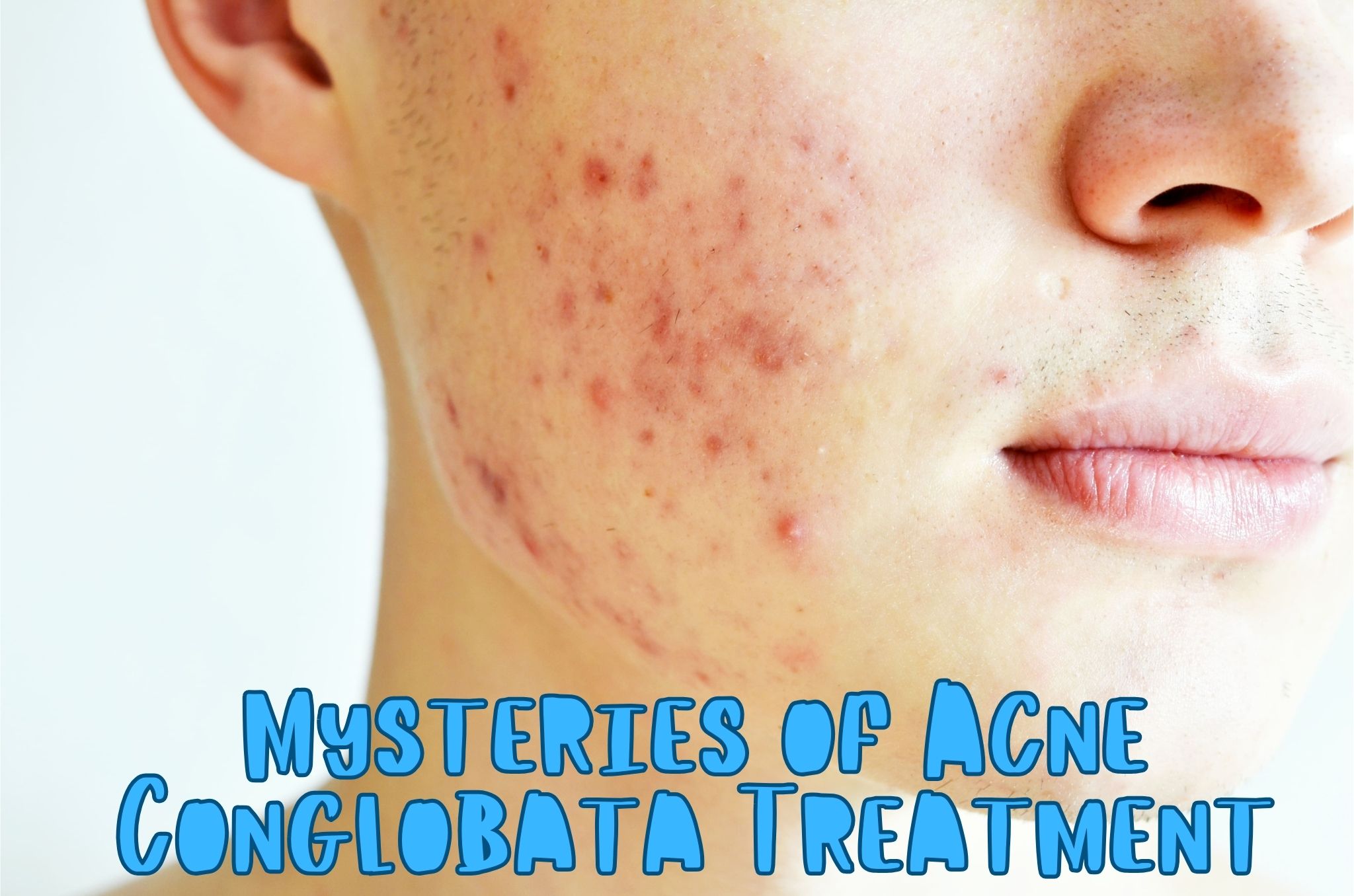 Decoding the Enigma: Acne Conglobata Treatment * 2024